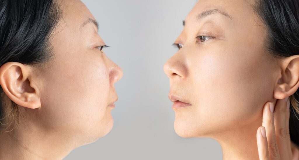 image of before and after of woman's face after a non-invasive face lift